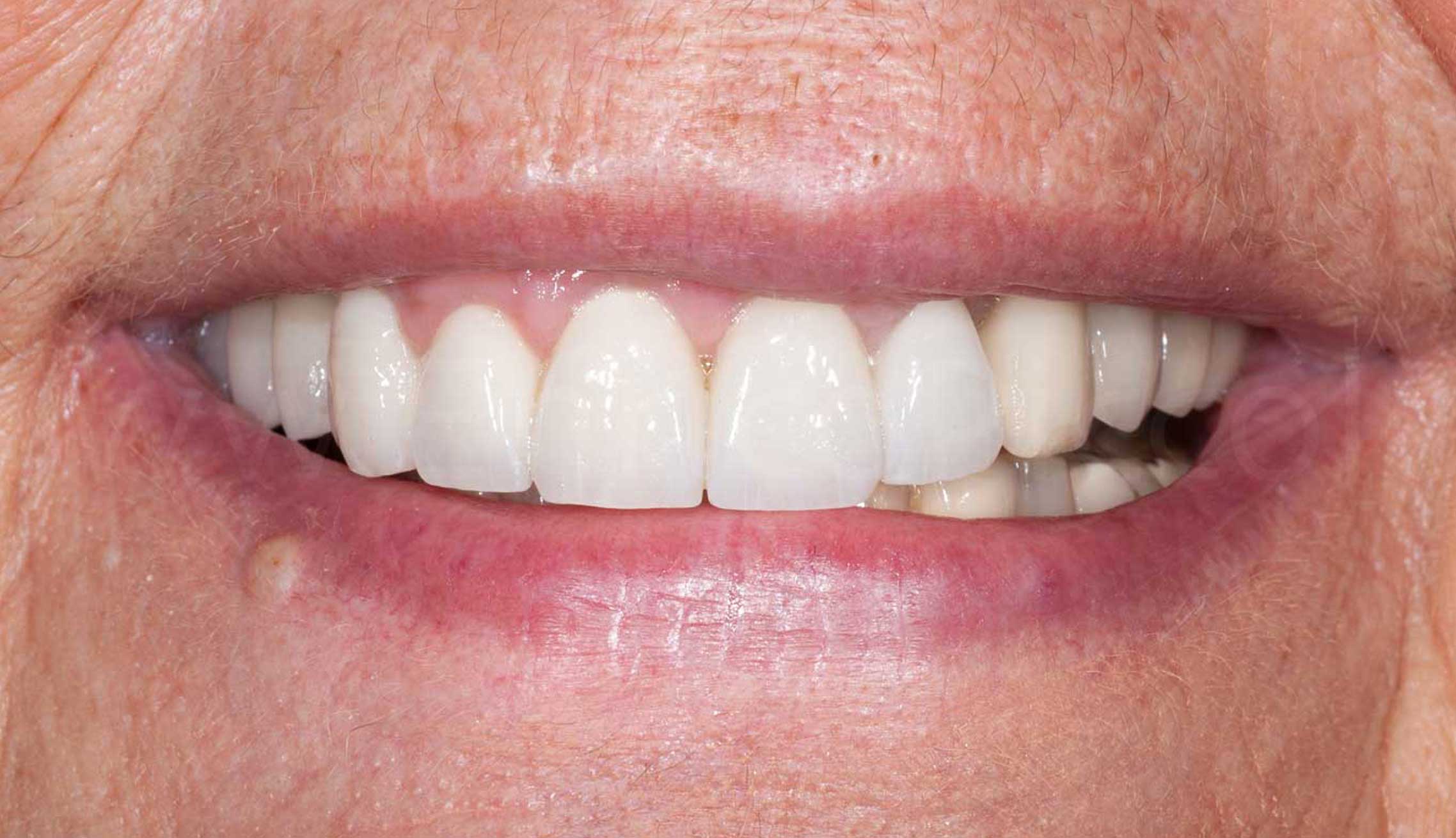 After image