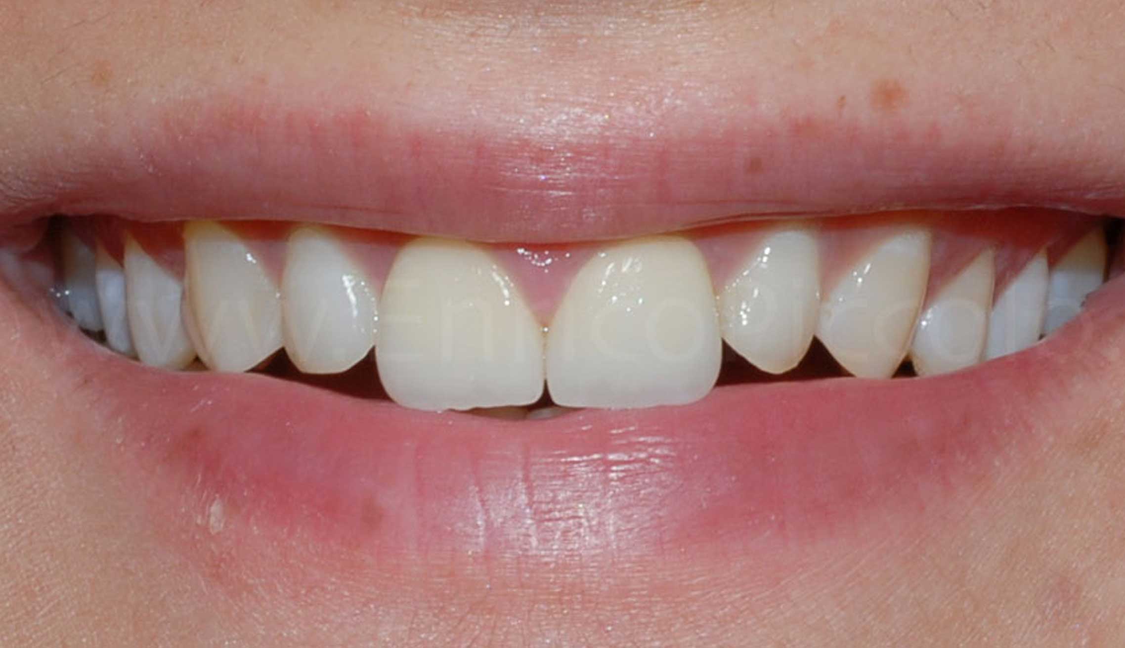 After image